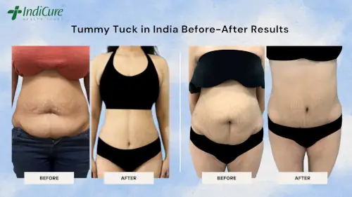 Tummy Tuck in India Before-After Results